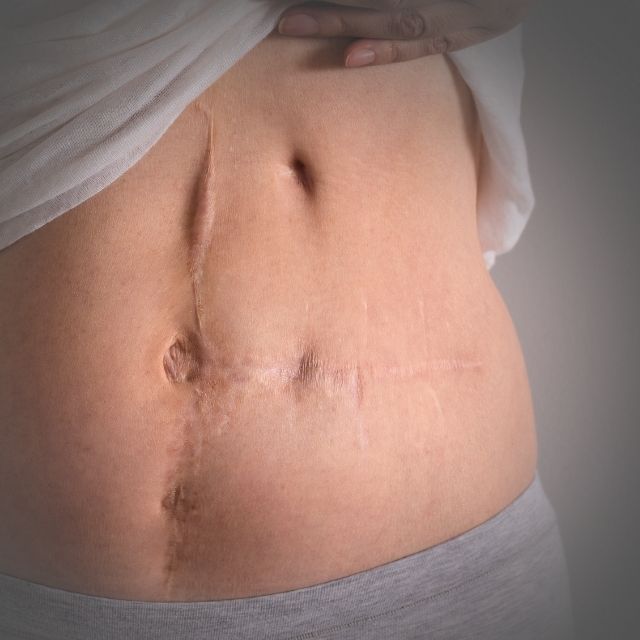 Cicatrici addominali: cosa fare? Come trattare le cicatrici?