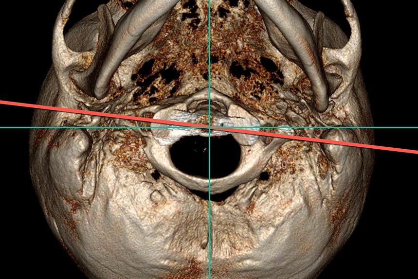 Tomografia Computerizzata della vertebra Atlante