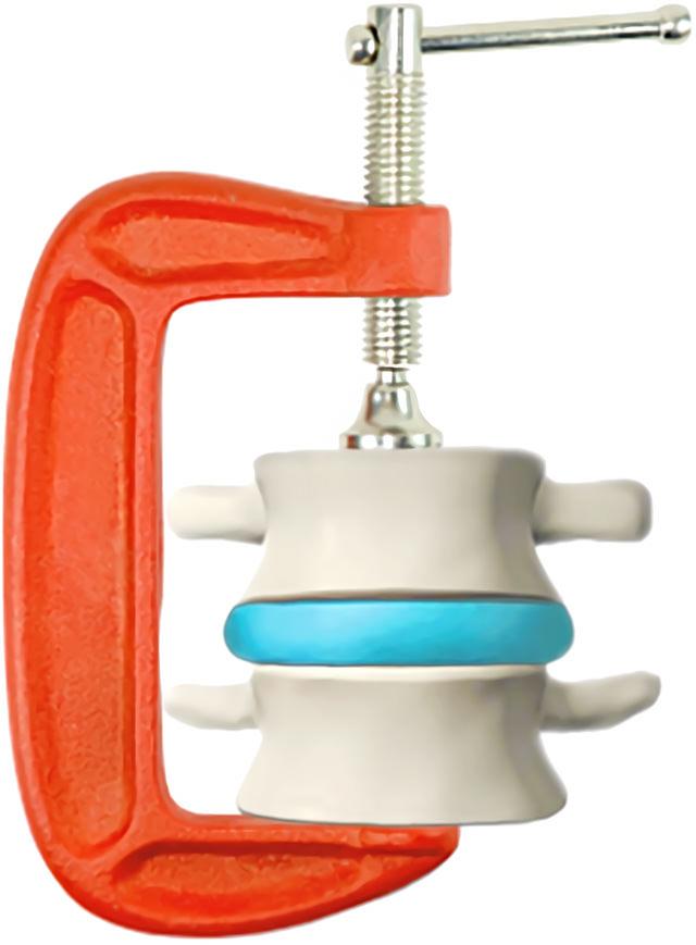 Compression d'un disque intervertébral comme dans un étau