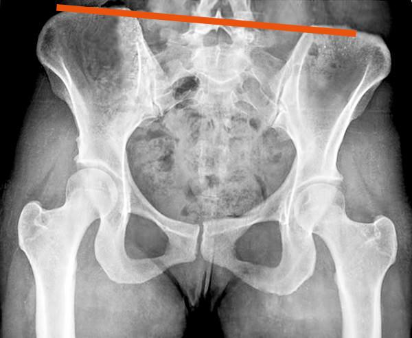 Röntgenaufnahme eines schiefen Beckens