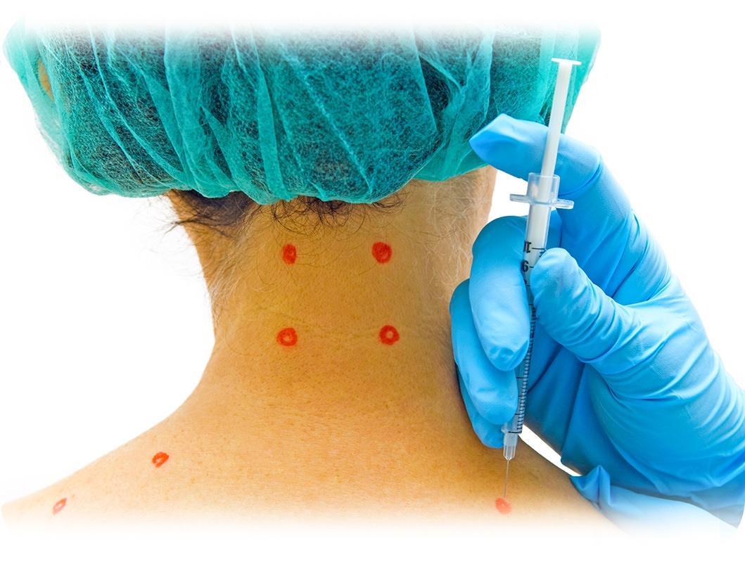 Injections de Botox contre la céphalée de tension Injections contre la céphalée de tension