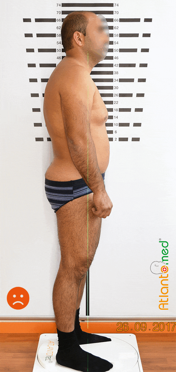 Changement postural après AtlantoMed Changement postural après le réalignement de l'Atlas