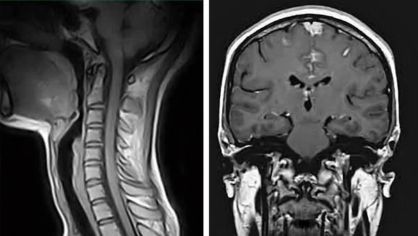Imagerie par résonance magnétique cervicale