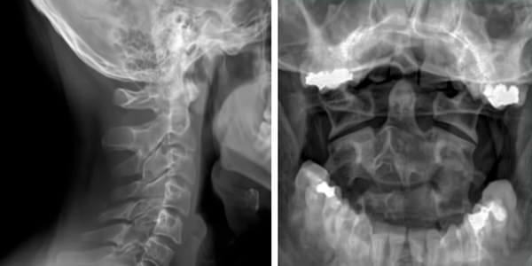 Radiographie cervicale et intraorale