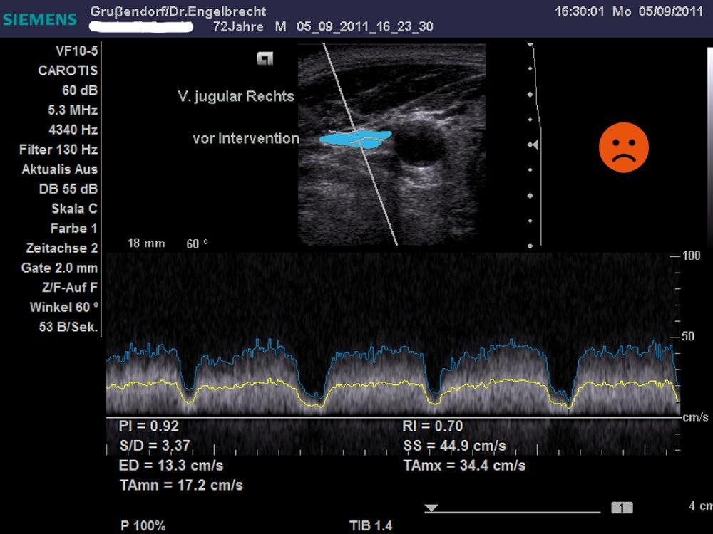 Ultrasound image of the compressed jugular vein before Atlas correction Ultrasound image of the compressed jugular vein before Atlas correction