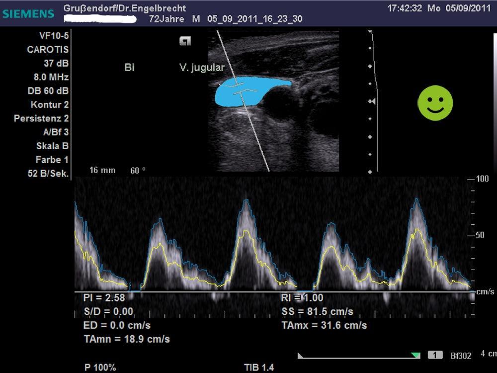 Ultrasound of the jugular vein after Atlas realignment Ultrasound of the jugular vein after Atlas realignment