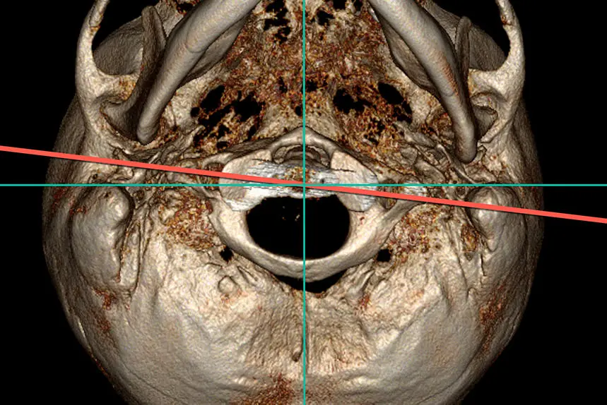Tomografía computarizada de las vértebras del Atlas