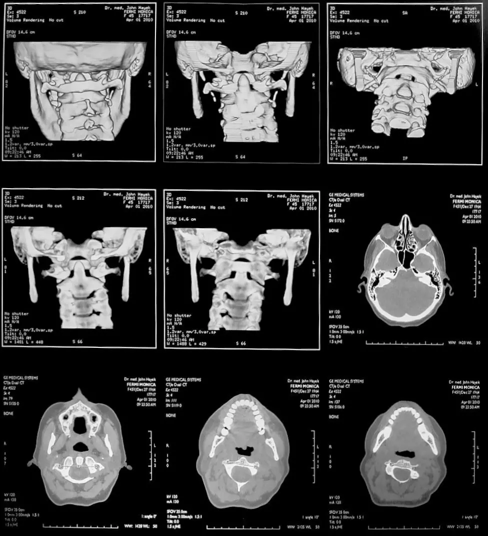 TC spirale /Tomografia del cranio e della vertebra Atlante