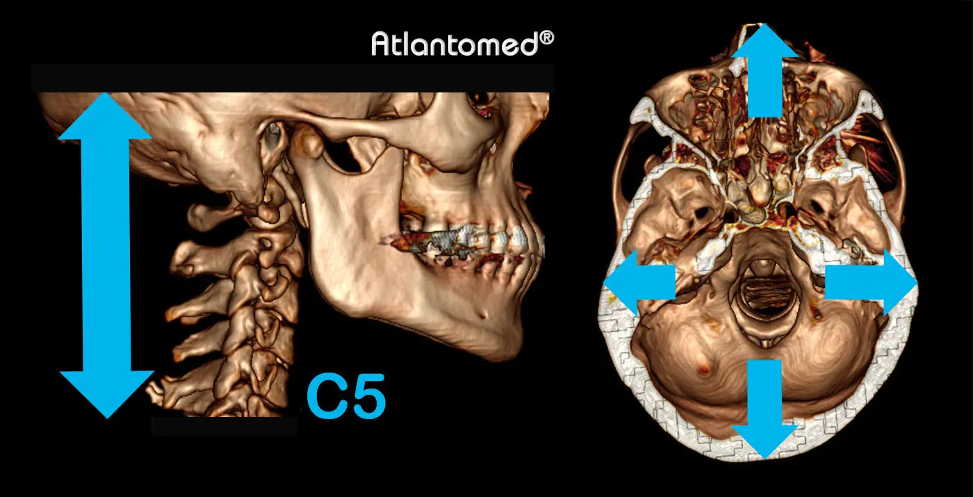 Spiral-CT des Schädels und Halswirbels mit Atlas und Axis