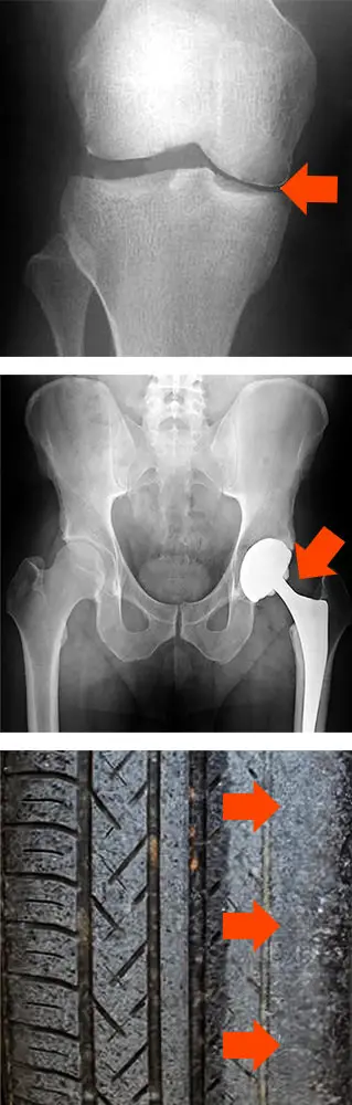 Dolore all'anca e alle ginocchia causato dalle articolazioni degenerate