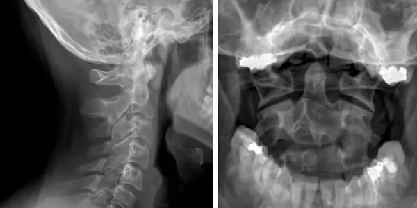 Zervikale und intraorale Radiographie